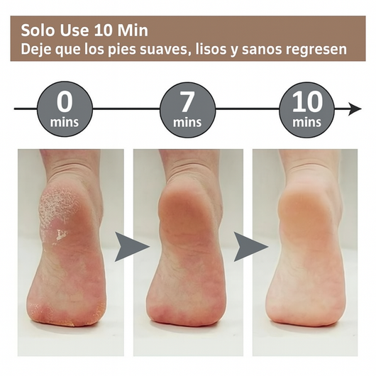 Removedor De Callos Electrico Lima